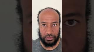 1 Year Afro Hair Transplant Turkey Results #shorts #hairtransplant #hairtransplantturkey