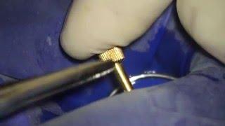 Dentatus screw post removal trick