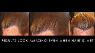 Best Hair Transplant Results – alviarmani