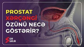 Kişilərdə prostat xərçəngi özünü necə göstəriri? (19.05.2023) - Medical Meida Live