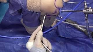 Reparación meniscal dentro fuera con el set Meniscal Protector