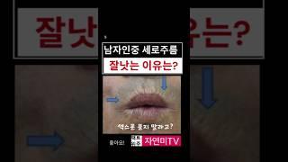 색소폰이 입술주름을 만든다고? #입술고양이주름 #신촌성형외과 #입술치마주름 ##인중세로주름 #은평성형외과 #홍대성형외과 #신촌성형외과 #입술보톡스 #입술주름영구교정 #입술필러