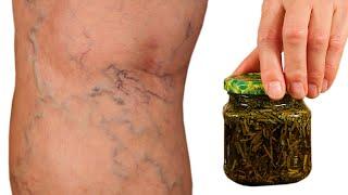 Incredible! Varicose veins disappear with the help of rosemary! A treasure that everyone should have