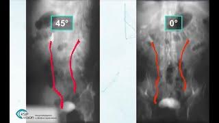 New AI Tool for Ureter Reconstruction from Fluoroscopic Images by RSIP Vision