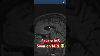 Severe MS seen on MRI 