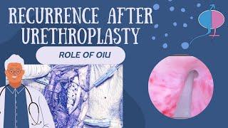 Role of OIU in Stricture after Urethroplasty