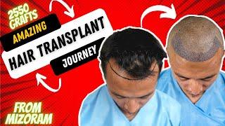 Hair Transplant In Mizoram | Best Results & Cost of Hair Transplant In Mizoram