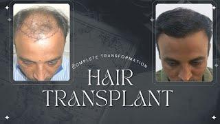 Hair transplant complete look transformation for Tahsildar sir Dr Manoj Bachhav