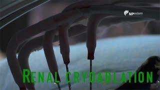 Renal Cryoablation