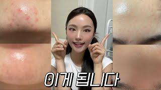 광고•좁쌀여드름 없애는 스킨케어방법 |일주일만에 좁쌀 없앤 루틴 대공개 |피지과다분비로 인한 좁쌀 드루와