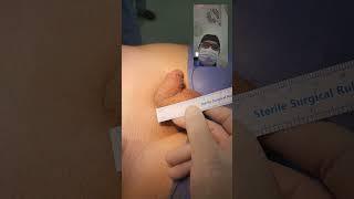 Penile enlargement surgery - Penis surgery - Dr . Araz Bayramov
