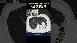 40년 기침·가래, 4분만에 해결하는 시술이 있다 !? (고운숨결내과 진성림)