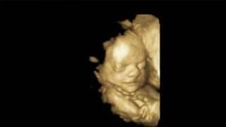 4D Ultrasound