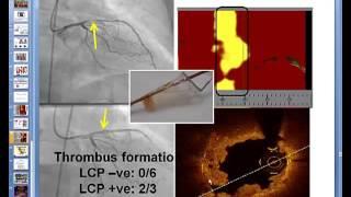 Coronary Near-Infrared Spectroscopy Review - part 2