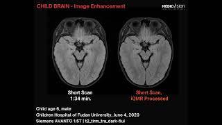 Child Brain MRI Scan - Image Enhancement