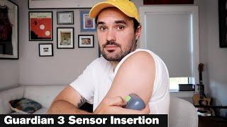 Medtronic Diabetes Guardian Sensor 3 Insertion - How to insert the Guardian 3 Sensor