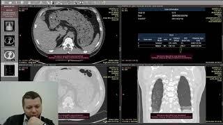 Сделал КТ легких. Что я увидел на снимках?