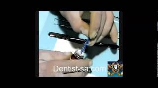 application of glass ionmer base - dentist-sa