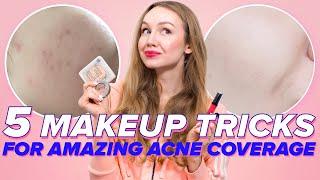 5 Makeup Tricks For Acne (how to cover acne marks and feel comfortable in your skin)