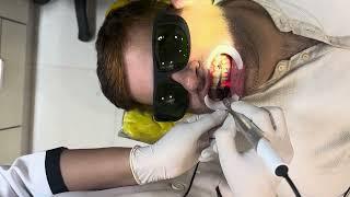 Laser treatment for bleeding gums