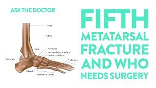 Ask the Doctor: Fifth metatarsal fracture and who needs surgery