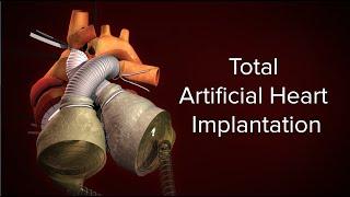 Medical Animation: Total Artificial Heart Implantation | Cincinnati Children's