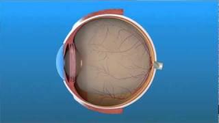 Vitrectomy Surgery for Detached Retina