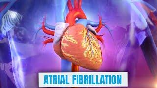 What is Atrial fibrillation?