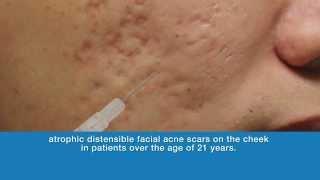 Bellafill® for Acne Scar Proposed Mechanism of Action