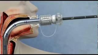 Food bolus retrieval using the GUARDUS™ Overtube and TALON™ Grasping Device