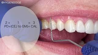 How to measure RECESSION, and CAL on the Buccal/Linguals