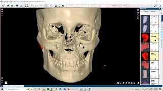 Webinar Orthodontics _The best solution for your Ortho treatments_English