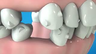 Most advanced Clear Aligner System | Invisalign® G Series of Innovation | Invisalign® G3 G4 G5 G6 G7