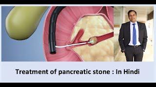 Endoscopy removal of stone in pancreas : In Hindi, Dr Vikas Singla