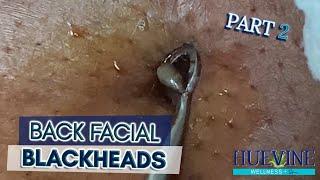 The Back Facial With A Blackened Cyst, Part 2 | HueVine