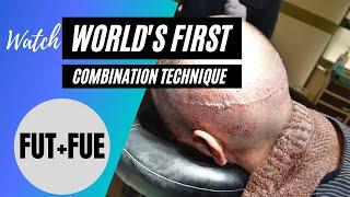 World's First Combination FUE+FUT hair transplant | Darling Buds Clinic