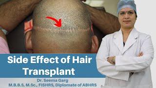 Side Effect of FUT Hair Transplant in India | Hair Transplant in India | Hair Transplantation India