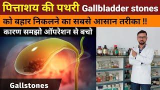 Gallbladder ki pathri ko bahar nikalne ka Aasan tarika | Gallstones symptoms, treatment, cause, diet