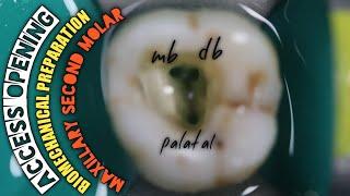 Access Opening in Maxillary Second Molar |Biomechanical Preparation | Protaper Rotary Endodontics