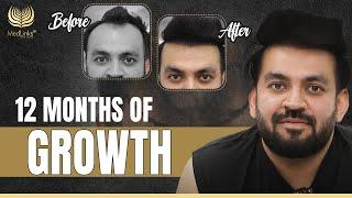 1 Year Post-Hair Transplant | 12 Months of Growth | MedLinks