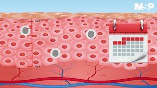 Psoriasis: una enfermedad que va más allá de la piel