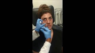 Dermal Filler-Restylane