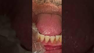 Vertex Denture #smile#toothfairy #flexible#dentistry#dentist