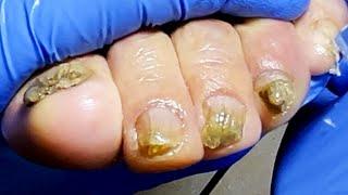 Trim all 5 toenails one by one and remove bad nails【Pedicure King】