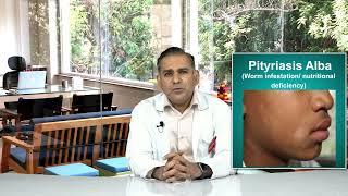 Vitiligo: Symptoms, Causes, Types & Management I                        Dr. Amit Vij