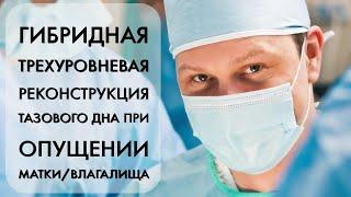 Гибридная трехуровневая реконструкция тазового дна при опущении матки/влагалища: базовая операция