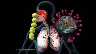 Upper Respiratory Tract Infections (URTI)