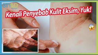 Ini Fakta Penyebab Kulit Mengalami Eksim! | STYLO