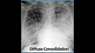 Abnormal x rays interpretation - Diffuse consolidation- Normal xays interpretation