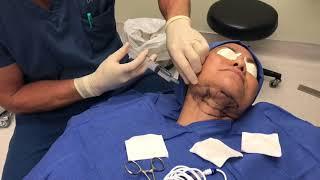 ThermiTight Procedure for Skin Tightening